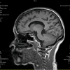 Cavernoma - Hình ảnh 5