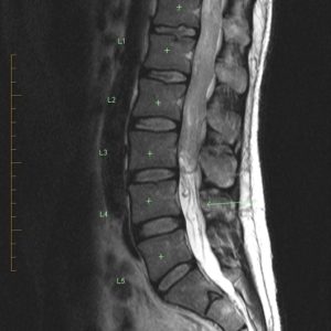 U bao dây thần kinh