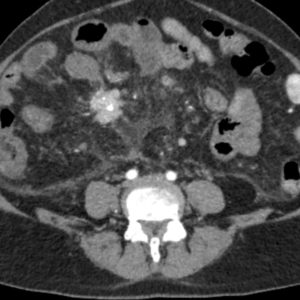 U thần kinh nội tiết