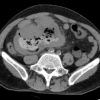 Lymphoma ruột non - Hình ảnh 2