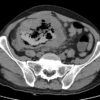 Lymphoma ruột non - Hình ảnh 4