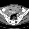 Lymphoma ruột non - Hình ảnh 4