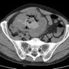 Lymphoma ruột non - Hình ảnh 5