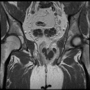 Apxe quanh hậu môn