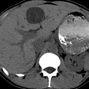 U tuyến đường mật