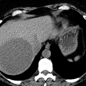 U tuyến đường mật