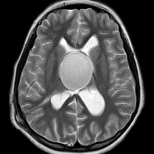 Nang keo não thất