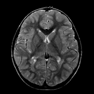 Chất xám lạc chỗ