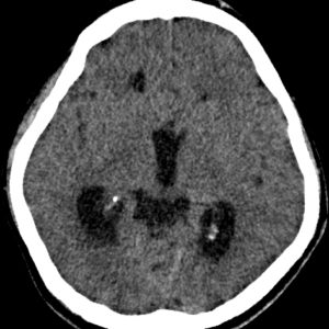 Thiểu sản thể chai