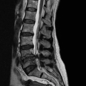 Nhiễm trùng cột sống