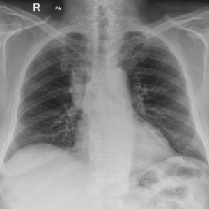 Nhiễm trùng cột sống