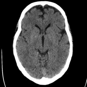 Nang vách trong suốt