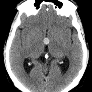 Nang keo não thất III