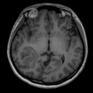 Loạn sản vỏ não