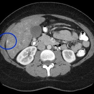 Hội chứng Fitz Hugh Curtis