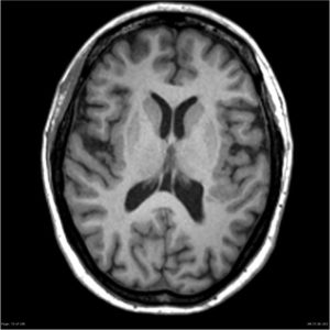 Loạn sản vỏ não