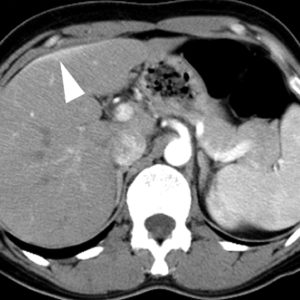 Hội chứng Fitz hugh curtis