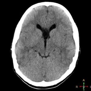 Nang vách trong suốt