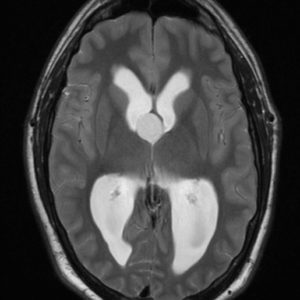 Nang keo não thất