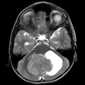 U đám rối mạch mạc