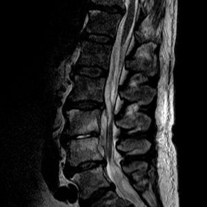 Nhiễm trùng cột sống