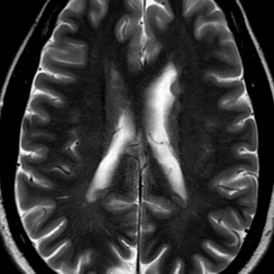 Chất xám lạc chỗ