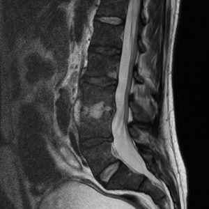 Nhiễm trùng cột sống