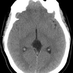 Nang vách trong suốt