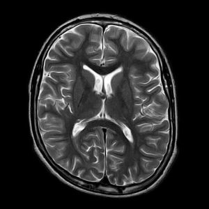 Nang keo não thất