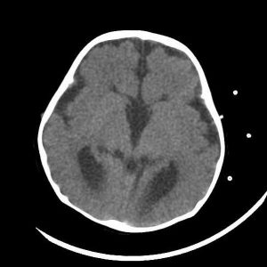 Bất sản thể chai