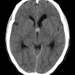 Nang keo não thất