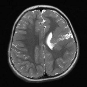 Nứt não thể môi đóng / Xung T2W