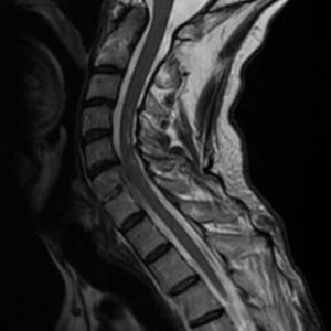 Viêm đốt sống - đĩa đệm