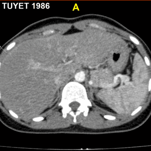 Hội Chứng Fitz-Hugh-Curtis