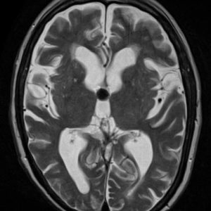 Nang keo não thất