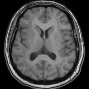 Chất xám lạc chỗ