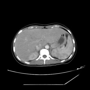 Hội chứng Fitz Hugh Curtis