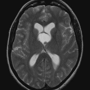 Nang keo não thất