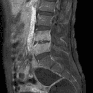 Nhiễm trùng cột sống