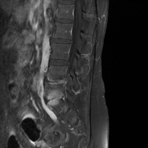 Nhiễm trùng cột sống
