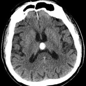 Nang keo não thất