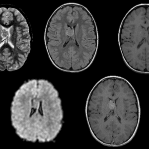 U đám rối mạch mạc
