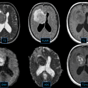 U thần kinh trung ương