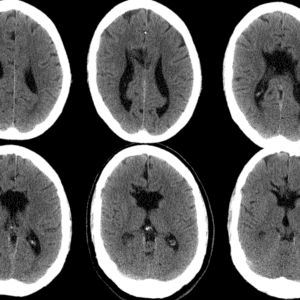 Thiểu sản thể chai