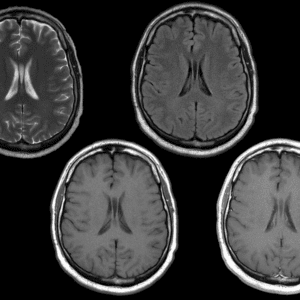 Nang vách trong suốt