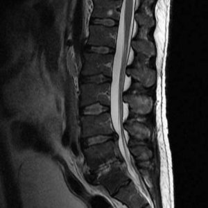 Nhiễm trùng cột sống