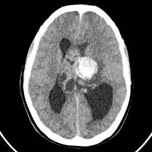 U tế bào TK trung ương