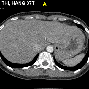 Hội chứng Fitz hugh curtis