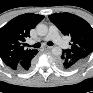 Nhiễm trùng cột sống