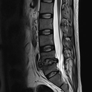 Nhiễm trùng cột sống